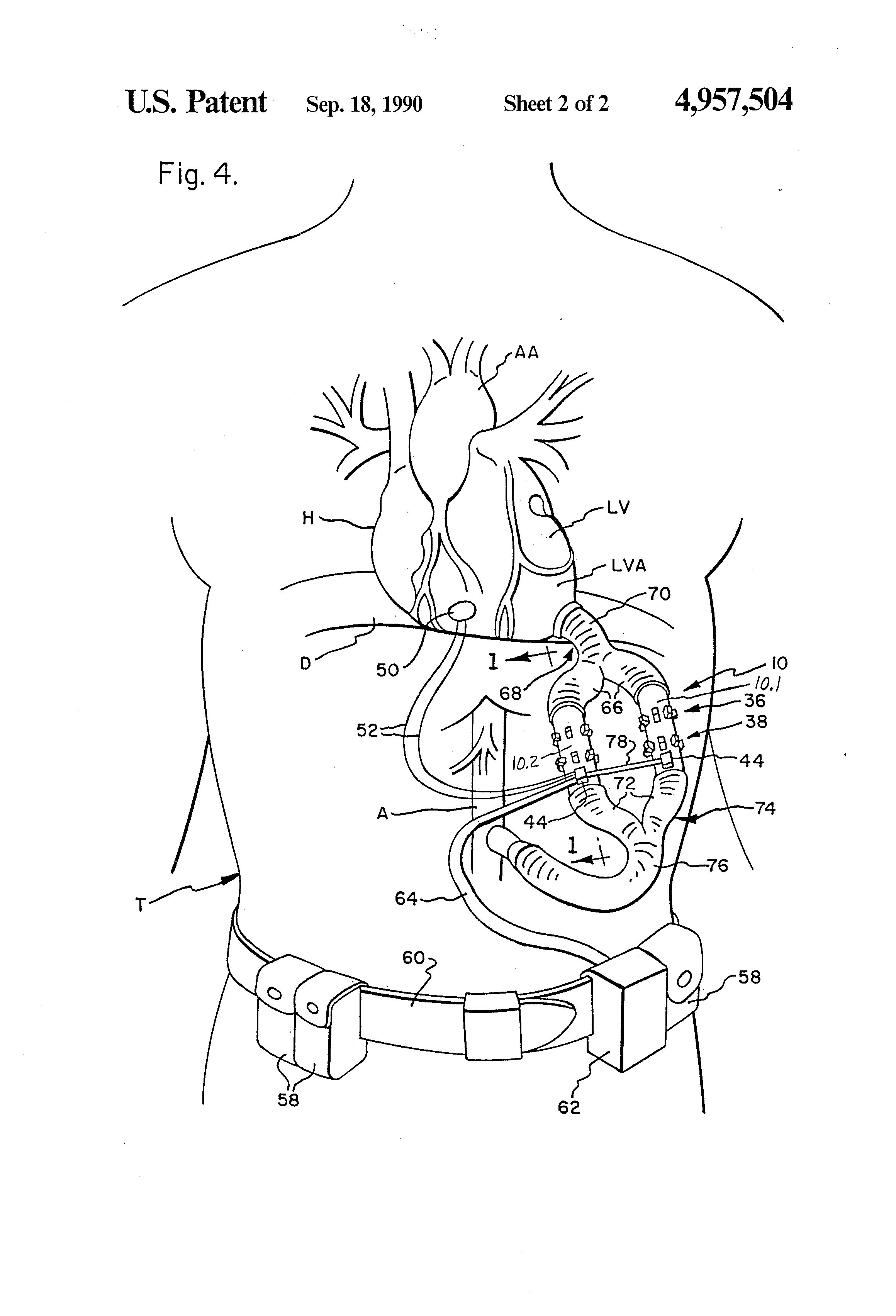 US4957504A, drawing sheet 2 of 4